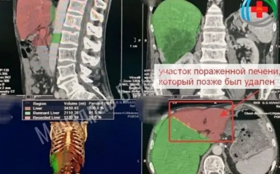 Жителю Башкирии вырезали часть печени и нарастили новую