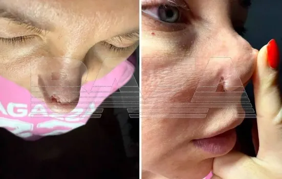 Пациентку изуродовал звездный хирург из Москвы: уфимка подала в суд после неудачной ринопластики