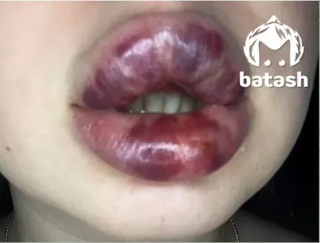 В салон красоты, где девушке испортили губы, нагрянула проверка: важные подробности