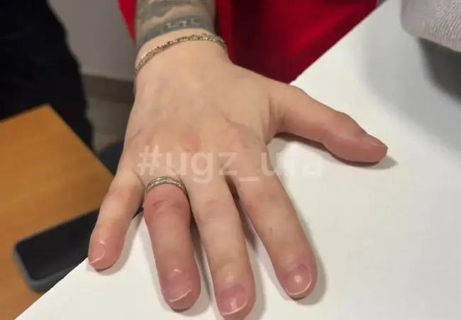 Спасатели Уфы помогли беременной женщине снять кольца с отекших пальцев